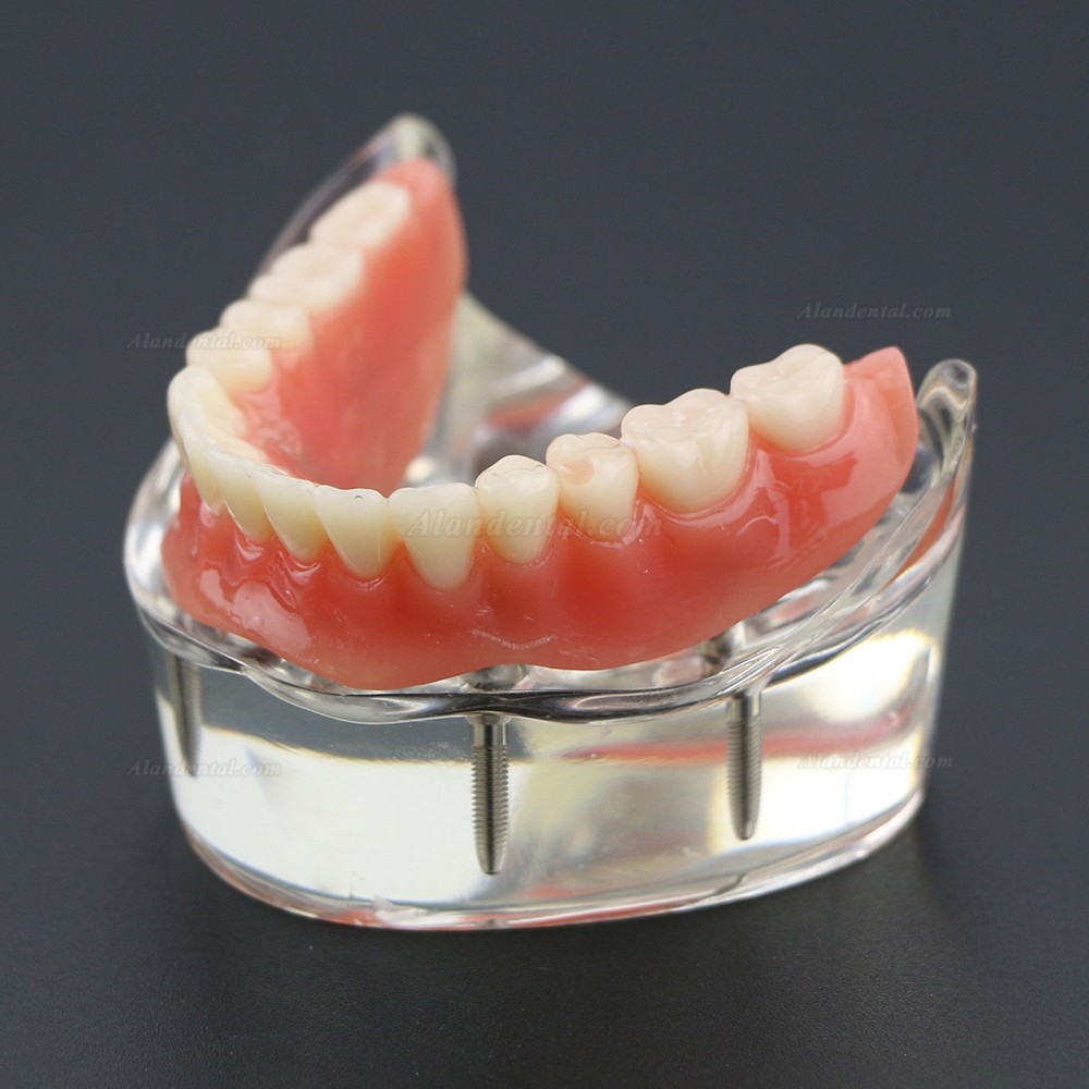 Dental Lower Teeth Demo Study Model 6002 02 Overdenture Inferior 4 Implants